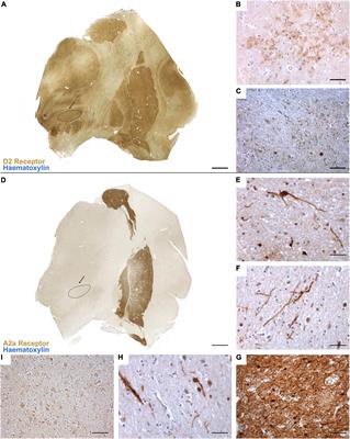 Topography and distribution of adenosine A2A and dopamine D2 receptors in the human Subthalamic Nucleus